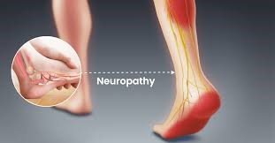 Neuropathy Treatment in Navi Mumbai